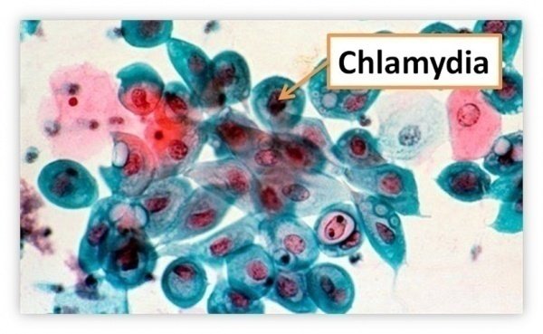 Bệnh chlamydia là gì?