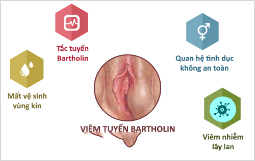Nguyên nhân gây ra viêm tuyến Bartholin
