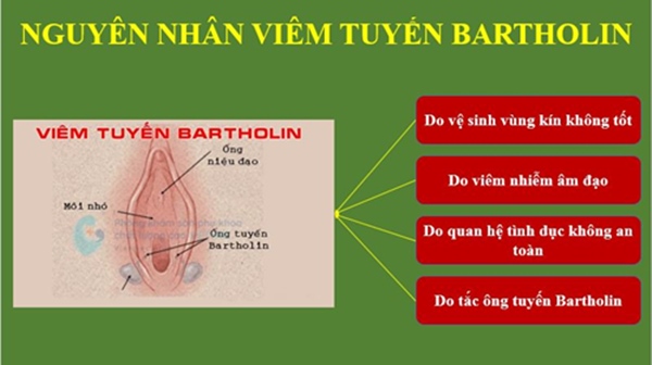 Nguyên nhân của viêm tuyến Bartholin